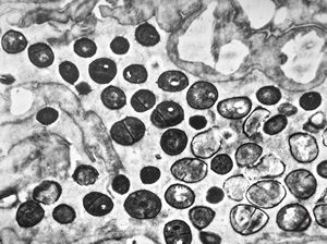 M,39y. | skin - folliculitis M,39y. | skin - folliculitis